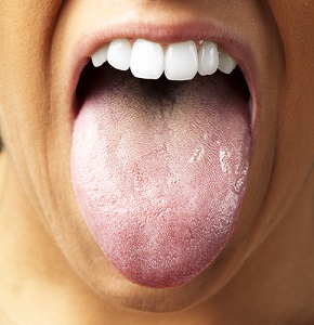 舌苔画像